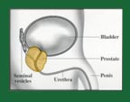 BPH is a non-cancerous enlargement of the prostate. Symptoms result when the enlargement squeezes the urethra where it runs through the prostate. BPH is the most common of prostate conditions among men; Prostatitis is an inflammation of the prostate. It is not contagious. It is sometimes caused by bacteria similar to those which cause other types of urinary infections; Prostate cancer is a malignant tumor that most often begins in the outer part of the prostate, but it may spread to the inner part.
